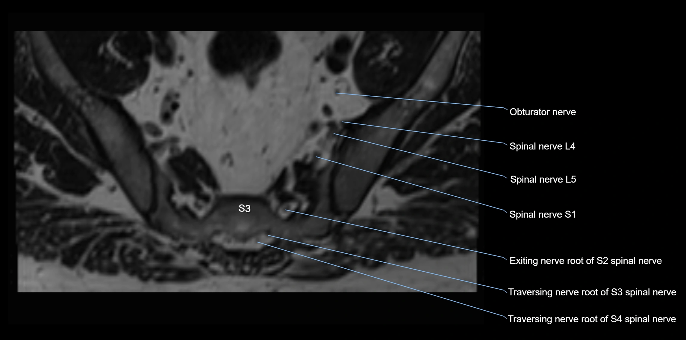 MR lumbosacral plexus axial cross sectional anatomy 3T  radiology  image-img-1008001-00090.webp